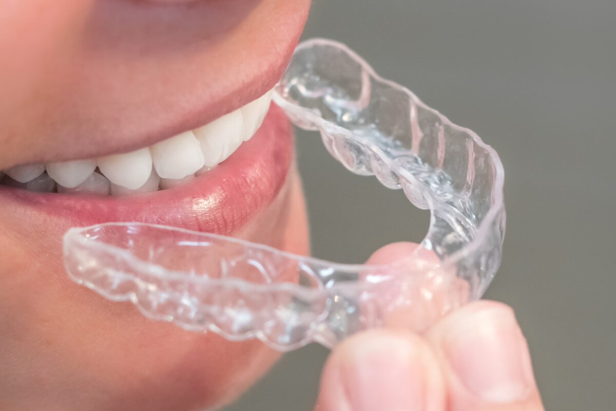 Learn About SureSmile Aligner Process In Eugene OR Area