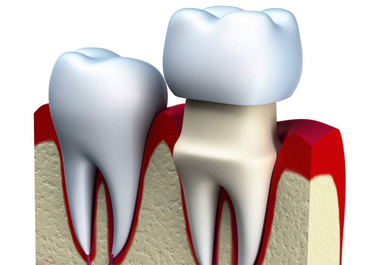Porcelain Tooth Crown Cost in Eugene OR Area