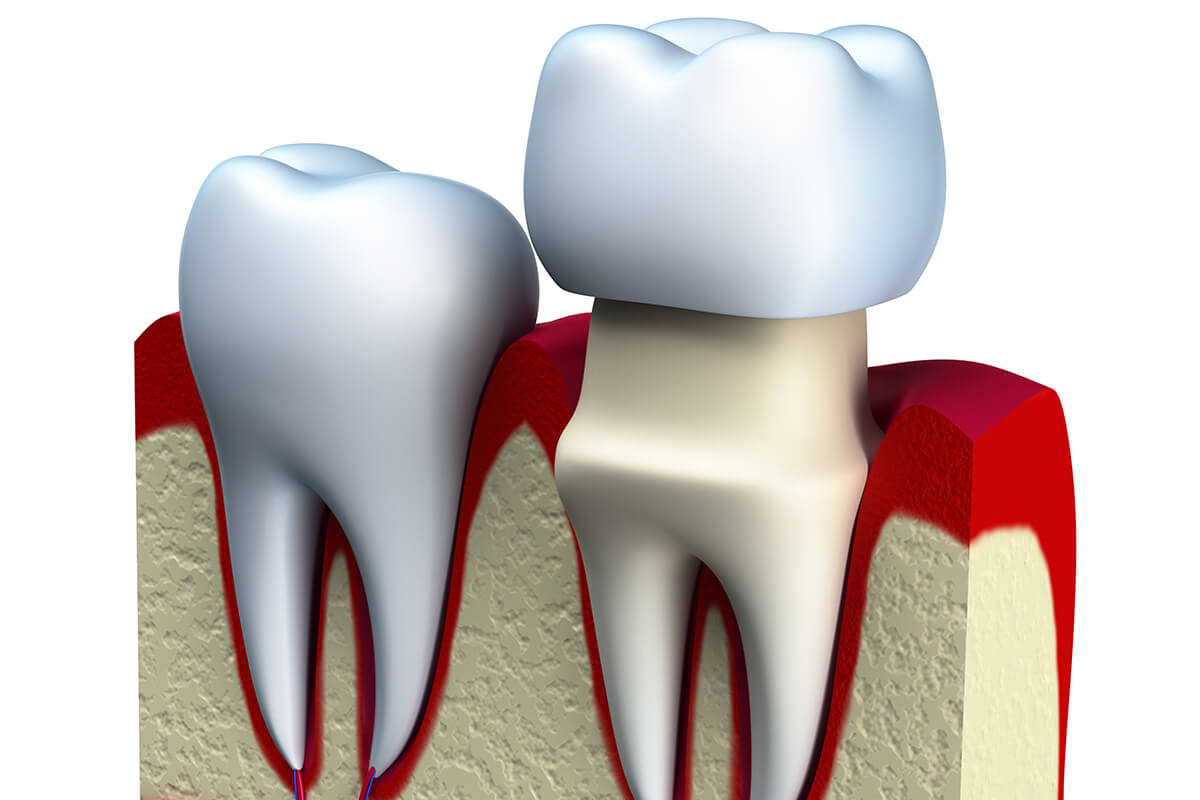 Porcelain Tooth Crown Cost in Eugene OR Area