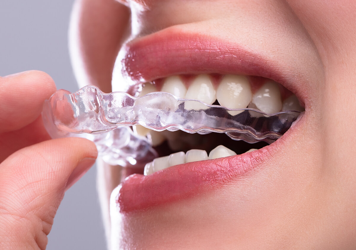 Suresmile Clear Aligners in Eugene OR Area