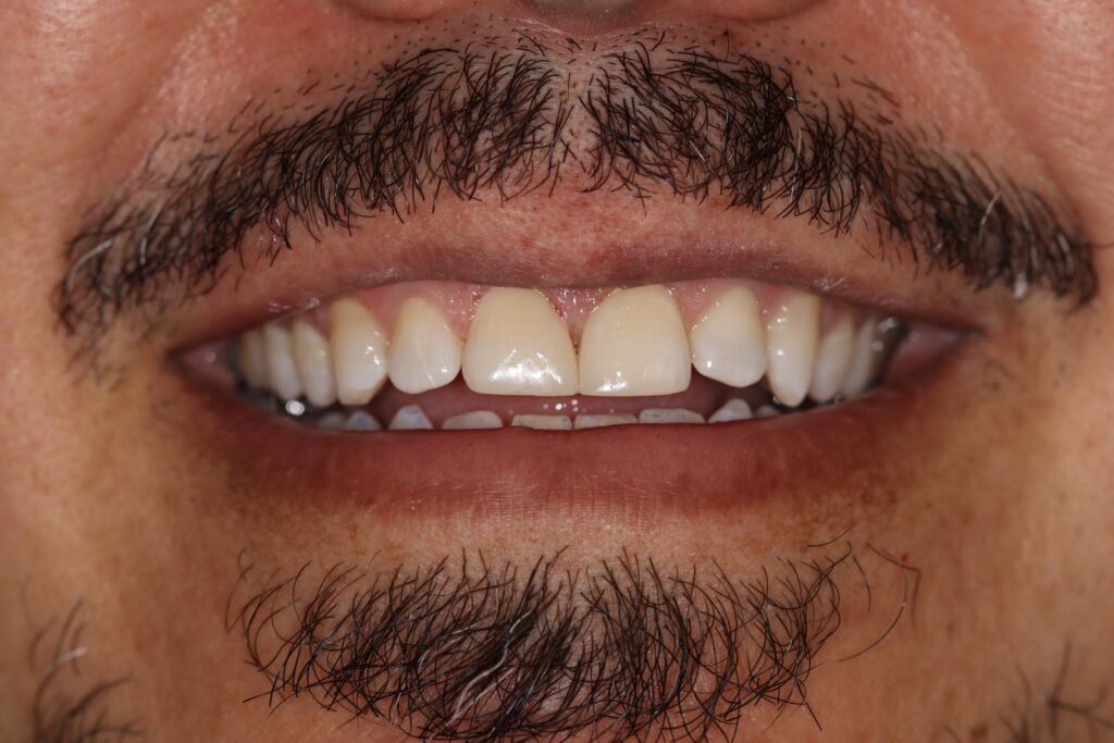 Close-up of a mouth with visible facial hair showing upper front teeth with crowns or veneers. The restorations are lighter and more opaque than adjacent natural teeth, highlighting contrast in color and texture.