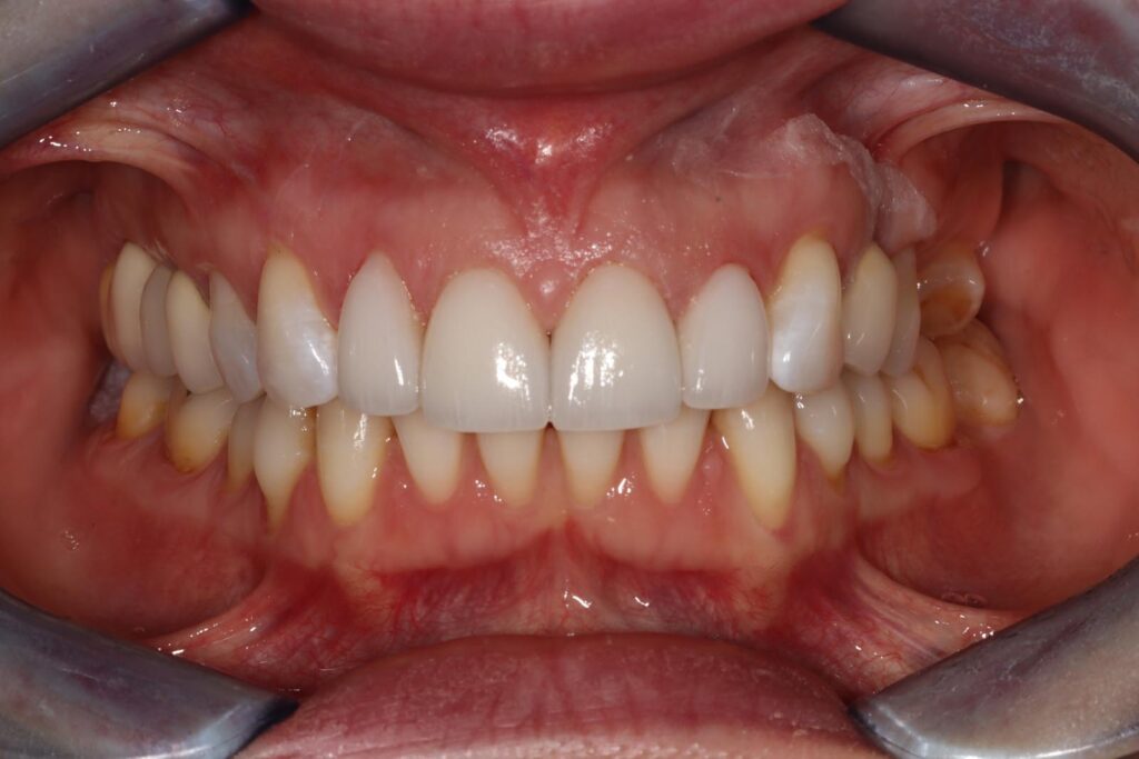 Close-up of a mouth showing upper and lower front teeth with smooth, white crowns or veneers. Natural teeth toward the back are less uniform, and gums show slight variation in color and texture.