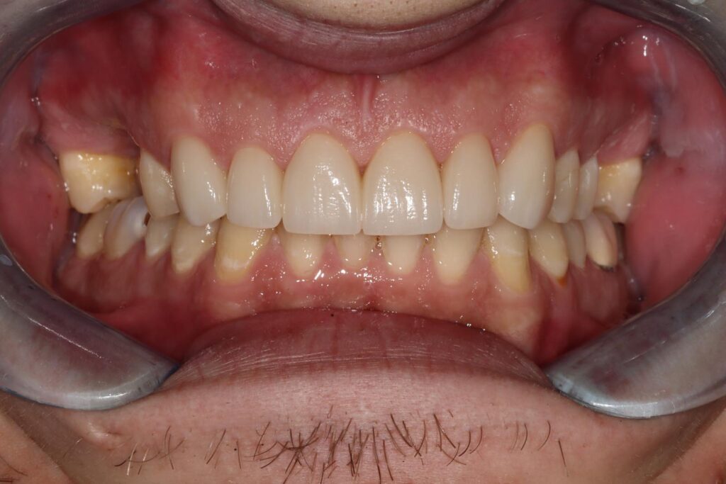 Close-up of a mouth with dental retractors showing clean, well-aligned upper and lower front teeth. Gums appear healthy and symmetrical, suitable for dental or orthodontic documentation.