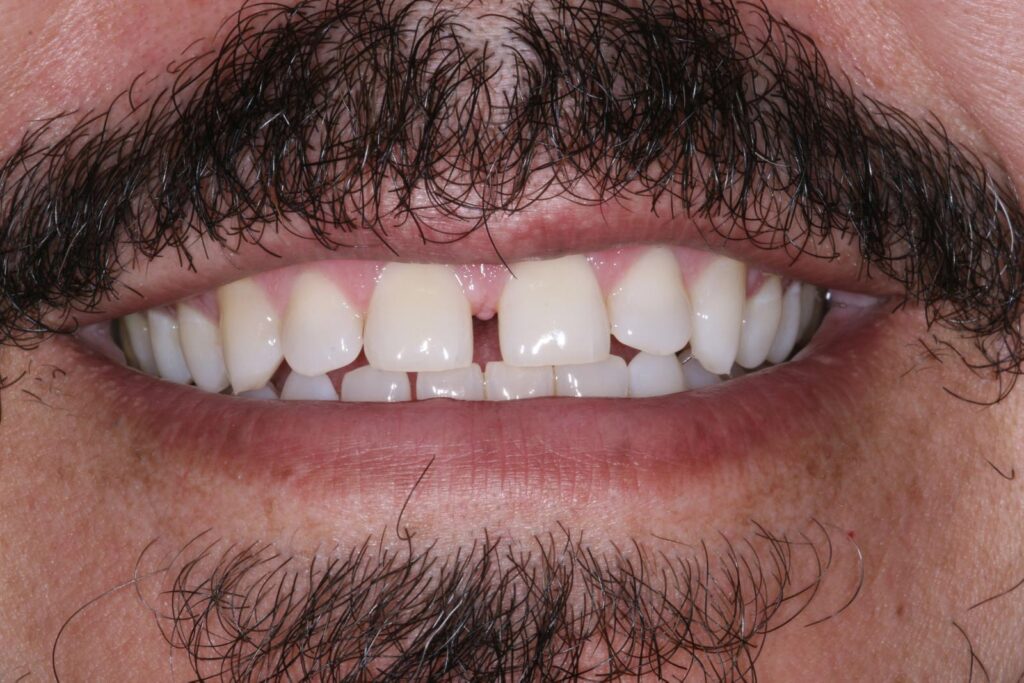 Close-up of a mouth with visible facial hair showing a gap between the upper central incisors. Teeth appear clean and naturally colored, with well-maintained oral hygiene.
