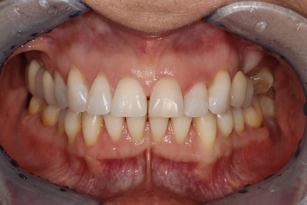 Close-up of a mouth with lips retracted showing upper and lower teeth with good alignment and visible molars. Gums are pink with mild redness in some areas, and molars show yellowing likely from plaque or staining.