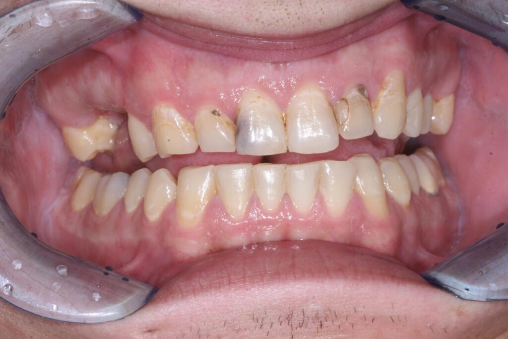 Close-up of a mouth with dental retractors showing upper front teeth with dark decay, cavities, and enamel erosion. Lower teeth are less affected but show wear and staining; gums are pink with mild inflammation