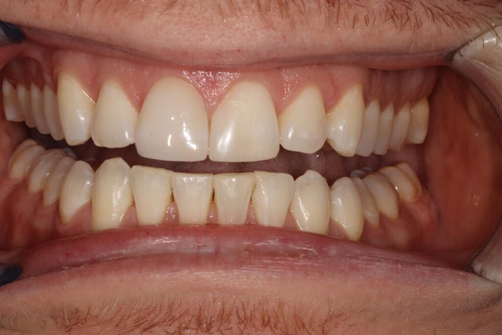 Close-up of a mouth with lips retracted showing well-aligned upper teeth and crowded lower front teeth. The gums are pink and healthy, with slight protrusion of the upper front teeth.