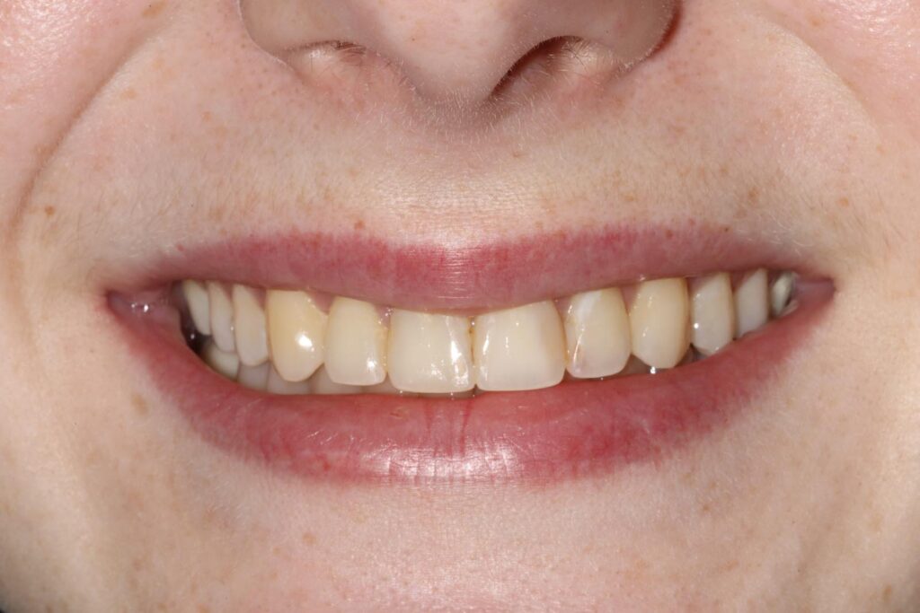 Close-up of a smiling mouth showing upper and lower teeth with slight color variation and spacing. Lips are parted, and surrounding skin has natural texture with visible freckles.