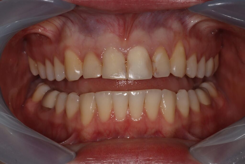 Close-up of a mouth with lips retracted showing aligned upper and lower teeth and healthy pink gums. No visible signs of inflammation or disease, suitable for orthodontic or dental evaluation.