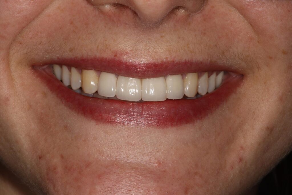Close-up of a smiling mouth showing mostly white, well-aligned teeth with two adjacent teeth appearing yellowed. Lips are parted, and surrounding skin has freckles and natural texture.