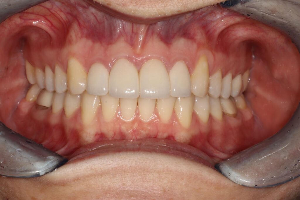 Close-up of a mouth with dental retractors showing clean, well-aligned upper and lower teeth meeting evenly. Gums are pink and healthy, with no visible signs of inflammation.