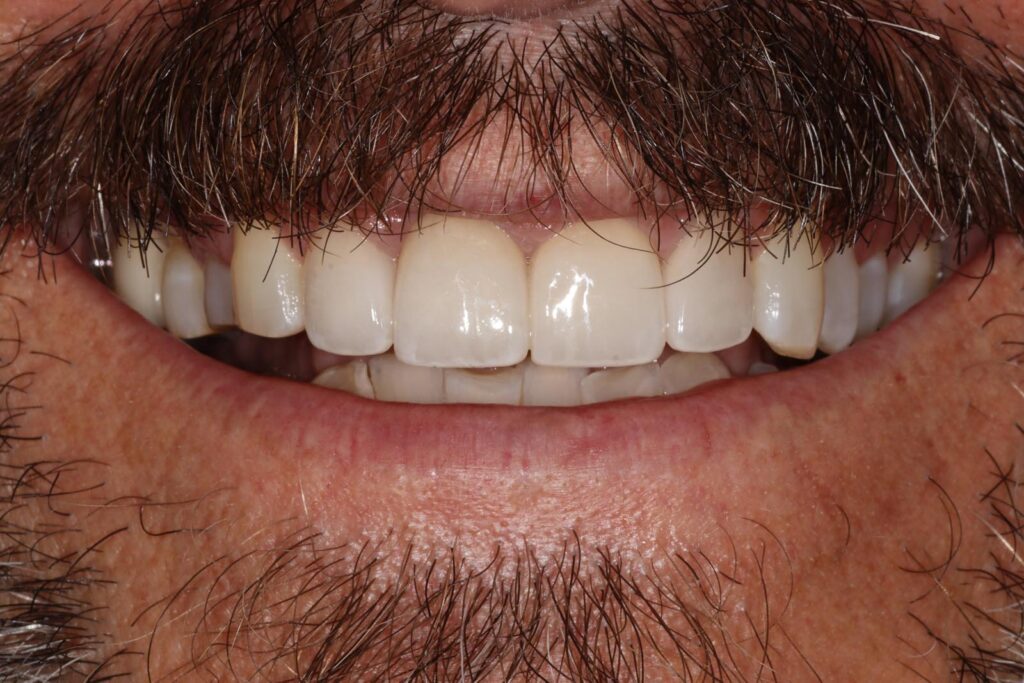 Close-up of a mouth with facial hair showing upper teeth with smooth, glossy veneers and natural lower teeth. The contrast in shape and finish highlights the difference between restored and untreated dentition.
