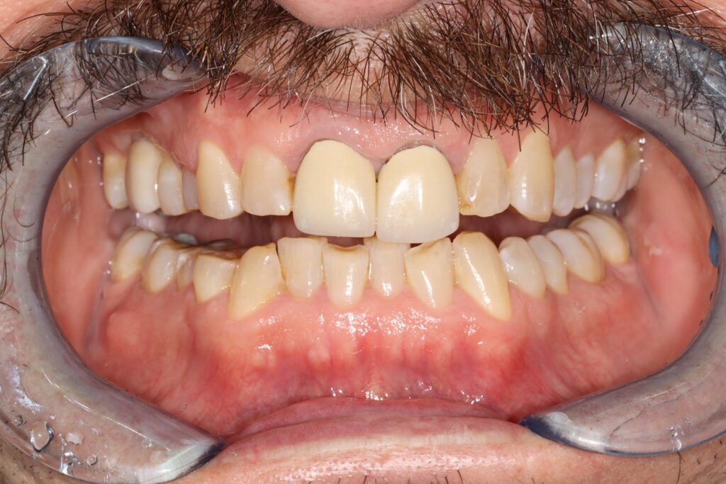Close-up of a mouth with dental retractors showing upper central incisors with lighter crowns or veneers. Lower teeth are crowded and discolored, highlighting contrast between restored and natural dentition.