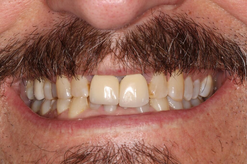 Close-up of a mouth with facial hair showing upper central incisors with bright, uniform crowns or veneers. Adjacent teeth are discolored and worn, emphasizing contrast between restored and natural dentition.