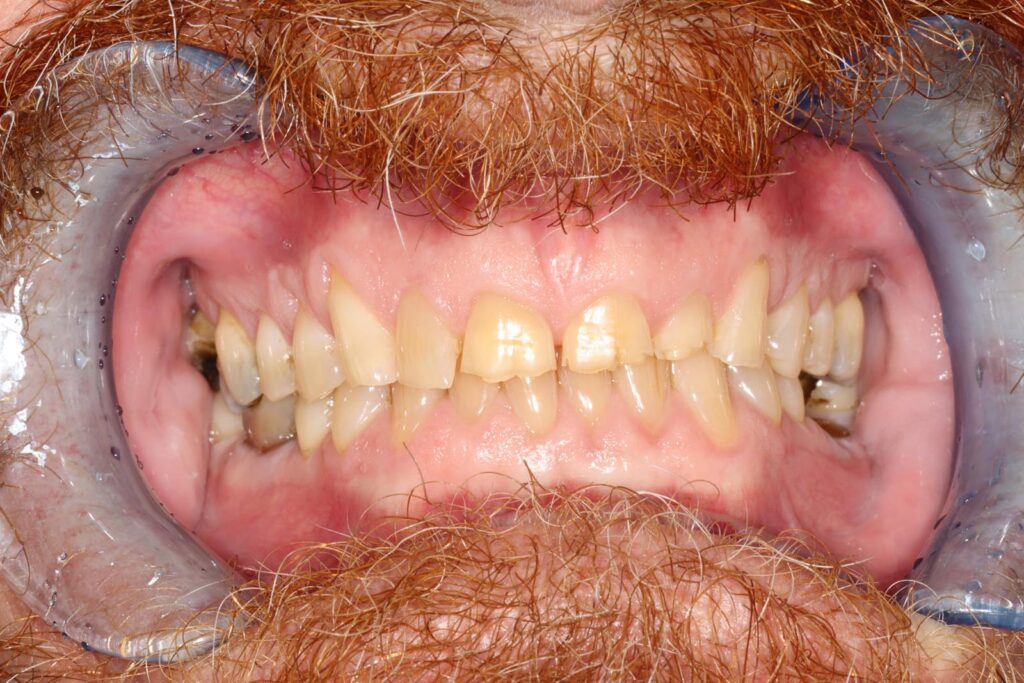Close-up of a person’s mouth with dental retractors exposing natural teeth and visible gums. The image highlights discoloration and wear, useful for assessing oral health and treatment needs.