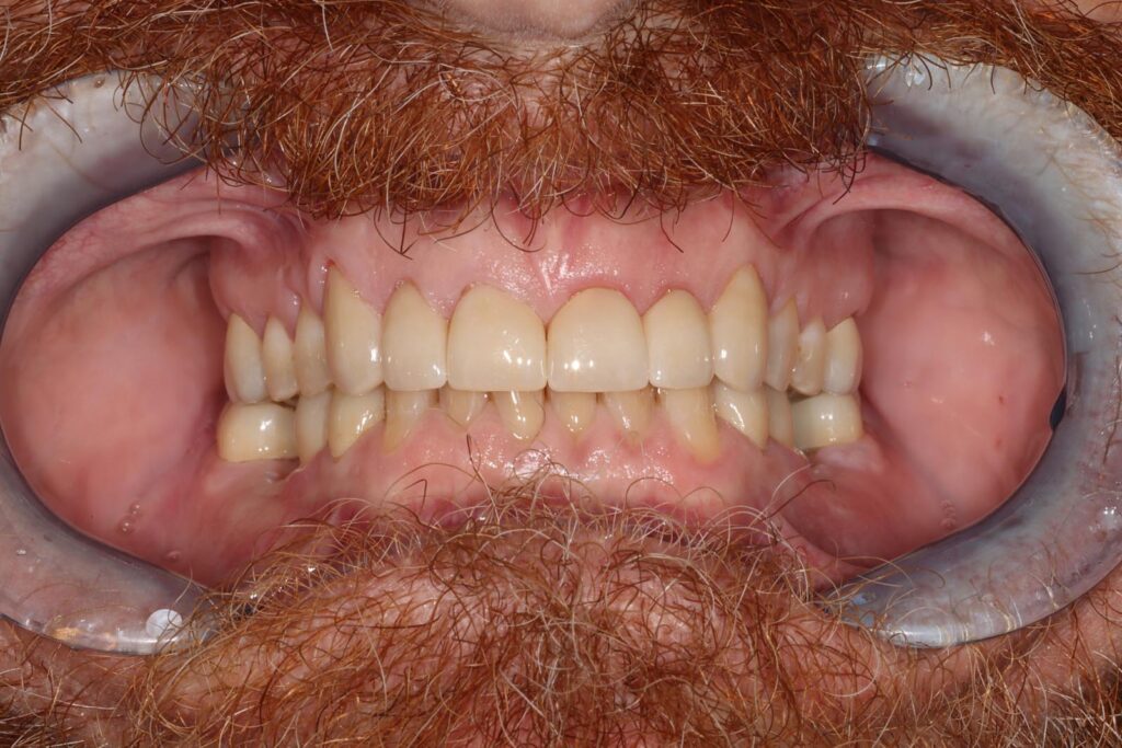 Close-up of a person’s mouth with dental retractors exposing both upper and lower arches in a closed bite. The image provides a clear view of tooth alignment and gum condition for clinical assessment.