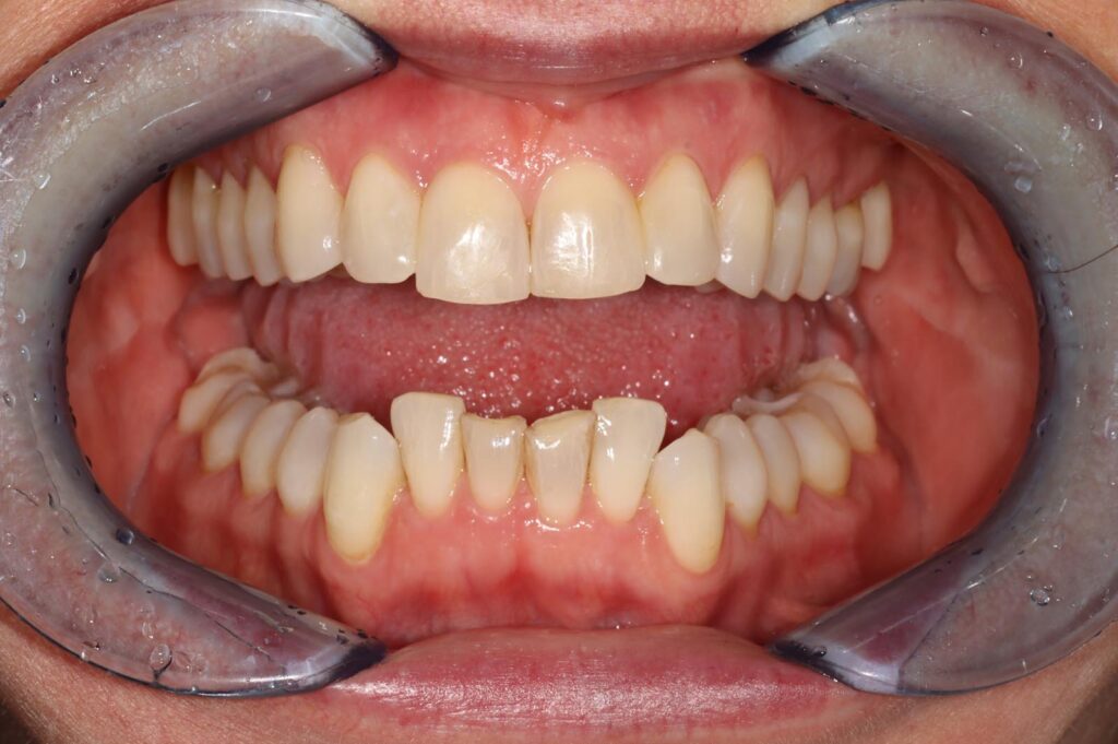Close-up of a mouth with cheek retractors showing well-aligned upper teeth and crowded lower front teeth. Gums appear healthy and pink, suitable for orthodontic evaluation.