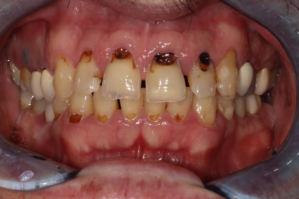Close-up of a mouth showing extensive decay, dark cavities, and erosion on upper front teeth. Misalignment, inflamed gums, and visible crowns indicate severe oral health issues and restorative interventions.