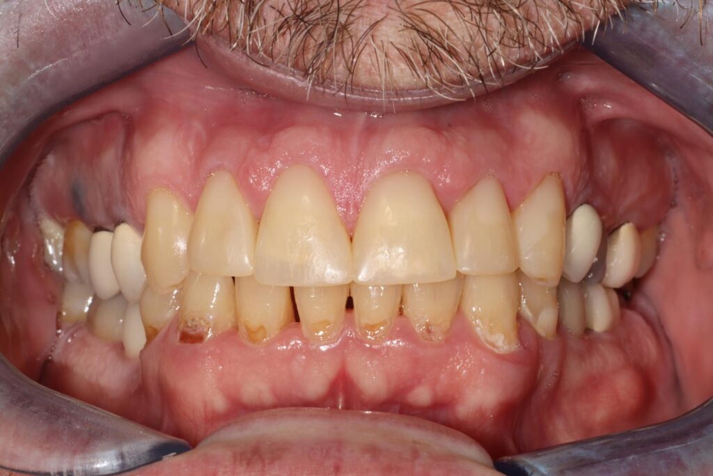 Close-up of a mouth with lips retracted showing teeth with brown staining, enamel wear, and multiple crowns. Inflamed gums and plaque buildup indicate oral health concerns and existing dental restorations.