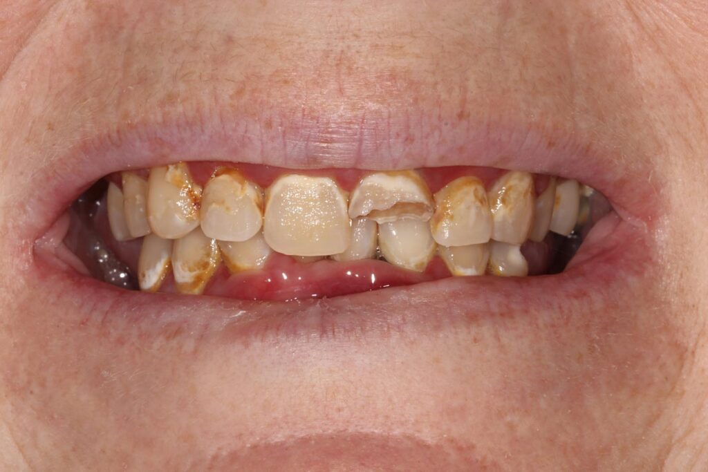 Close-up of a mouth showing brown stains, enamel erosion, and chipping on upper front teeth. Slight gum inflammation suggests poor oral hygiene or underlying dental issues.