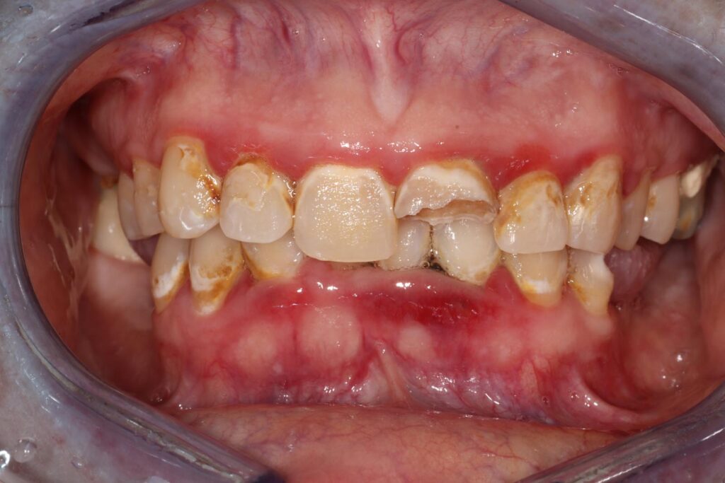 Close-up of a mouth showing severe enamel erosion, discoloration, and decay on upper and lower front teeth. Inflamed red gums suggest gingivitis or periodontal disease, highlighting advanced oral health issues.