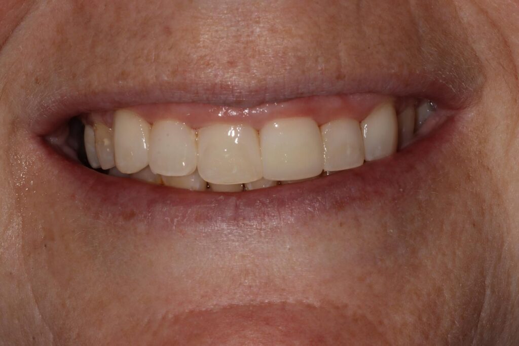 Close-up of a smiling mouth showing clean, well-aligned upper teeth with visible crowns or restorations. The gums appear healthy, and the image suggests maintained oral hygiene and cosmetic dental work.