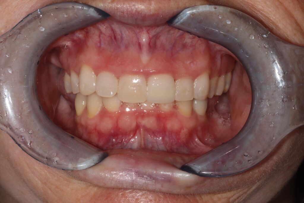Close-up of a mouth with cheek retractors exposing upper and lower teeth, some with visible crowns. Gums appear pink with mild redness, and oral tissues are clearly visible for clinical evaluation.