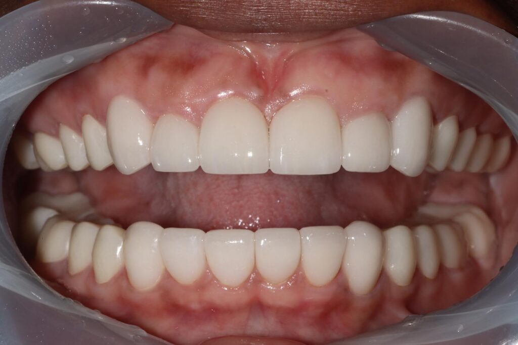 Close-up of a mouth with dental retractors exposing upper and lower teeth fitted with crowns or veneers. The teeth are uniformly shaped and colored, with healthy pink gums and symmetrical alignment.