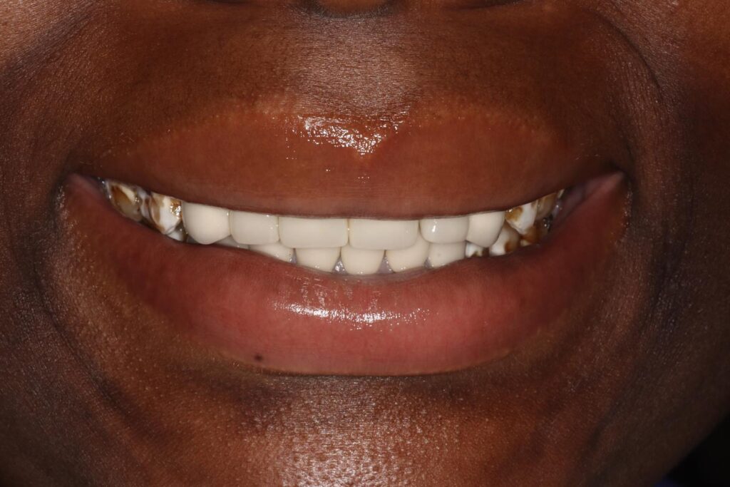 Close-up of a smiling mouth showing dental crowns or veneers on the front teeth with uniform color and shape. Natural teeth at the sides appear discolored, highlighting contrast between restorations and untreated areas.