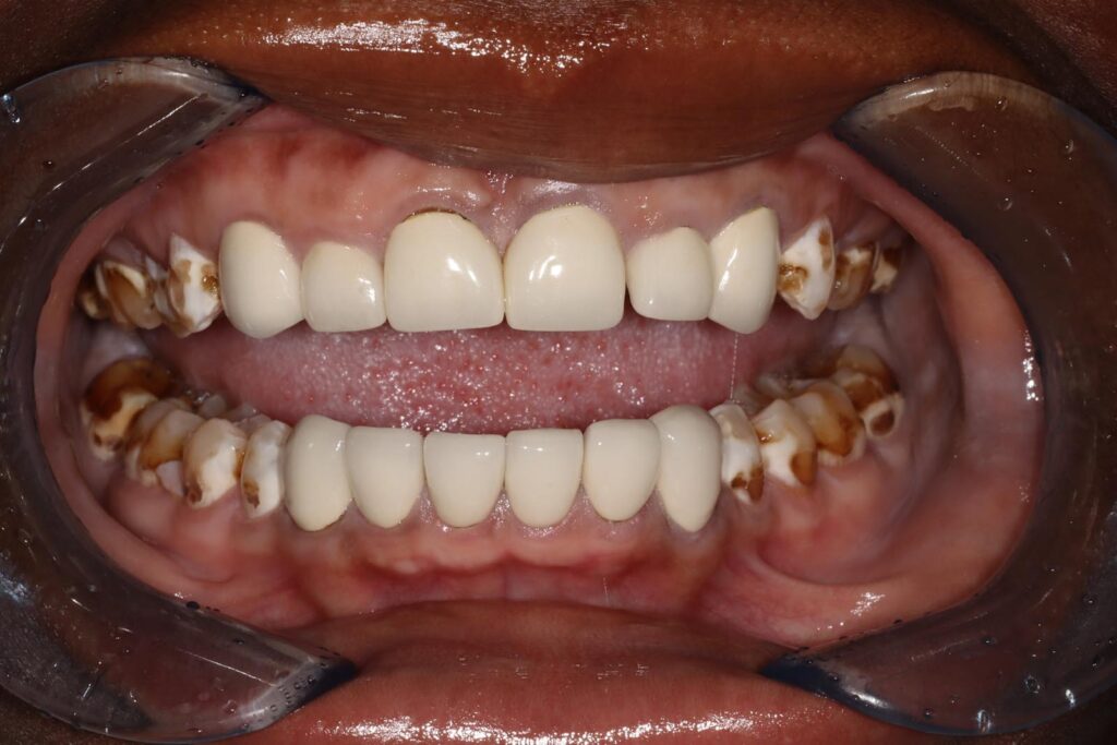 Close-up of a mouth with dental retractors showing white crowns or veneers on front teeth and severe brown decay on molars. The image contrasts restored and untreated areas, highlighting dental disease and cosmetic intervention.