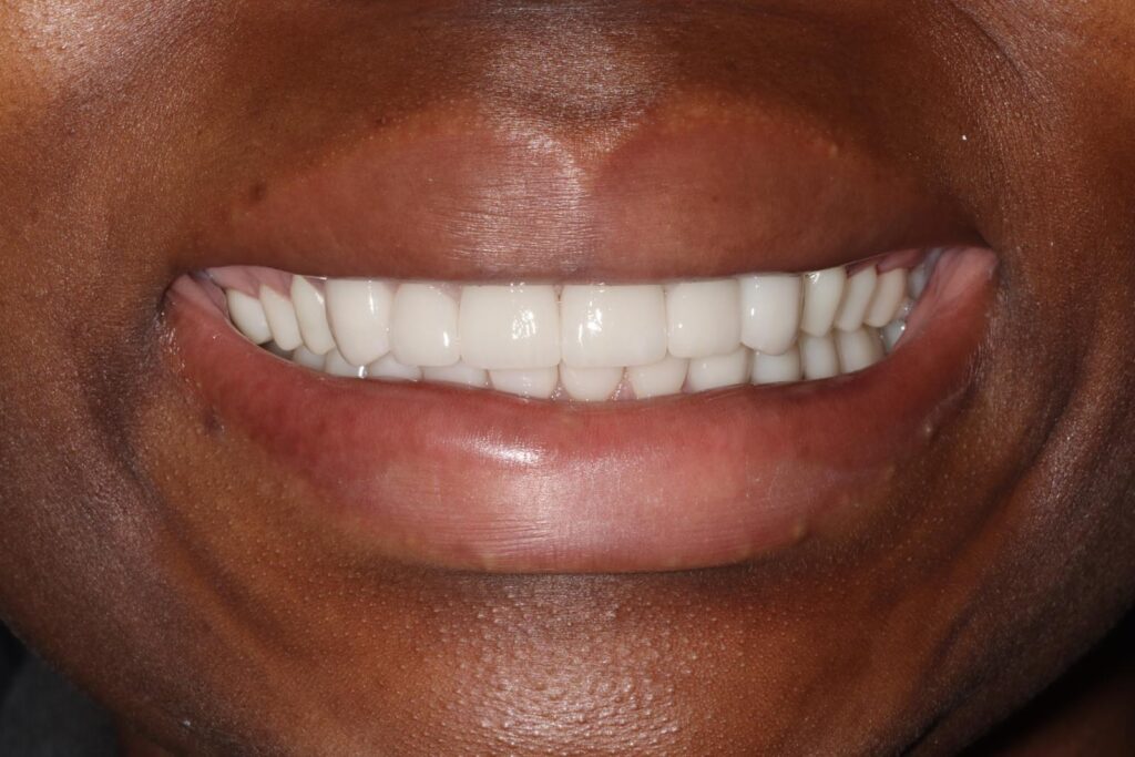 Close-up of a person’s mouth with lips parted, revealing clean, well-aligned upper and lower teeth. The uniform shape and bright color suggest dental veneers or crowns.