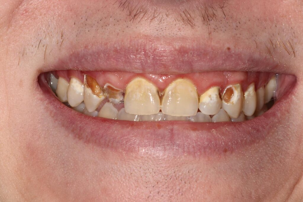 Close-up of a mouth showing upper front teeth with brown and yellow staining, decay, and structural damage. Gums appear slightly inflamed near affected teeth, indicating poor oral hygiene and possible enamel erosion.