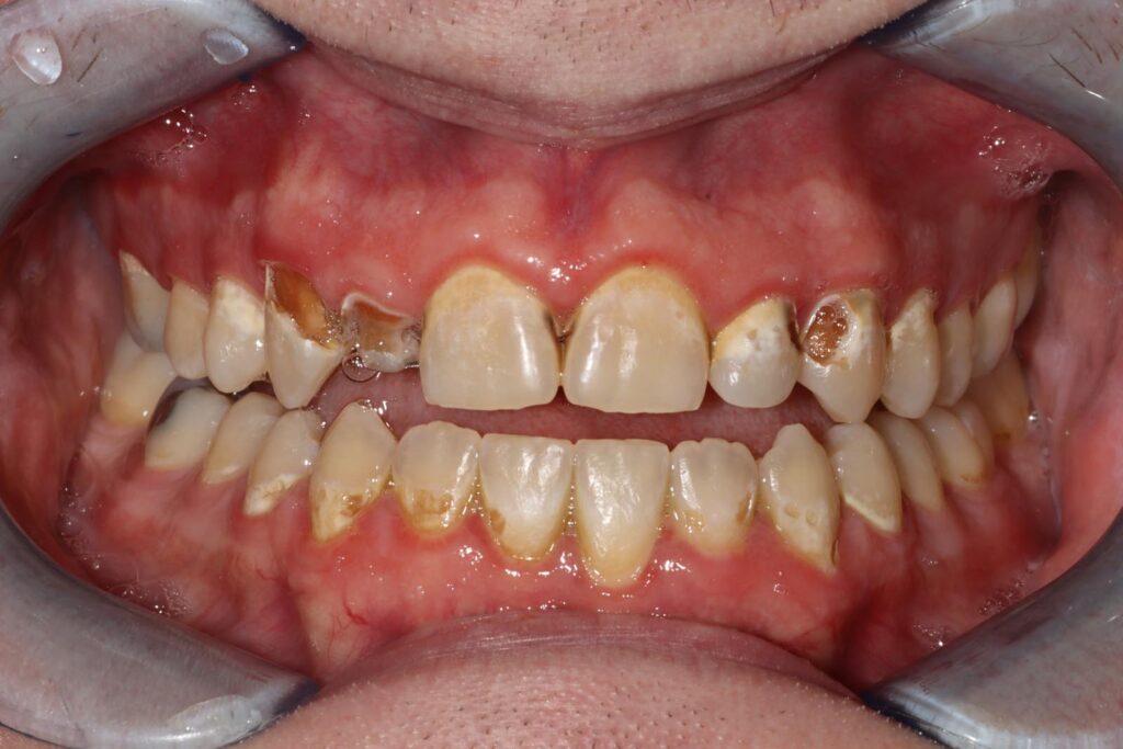 Close-up of a mouth with lips retracted showing upper and lower teeth with extensive decay, discoloration, and plaque. Several upper teeth have visible cavities and dark areas, and the gums appear red and inflamed