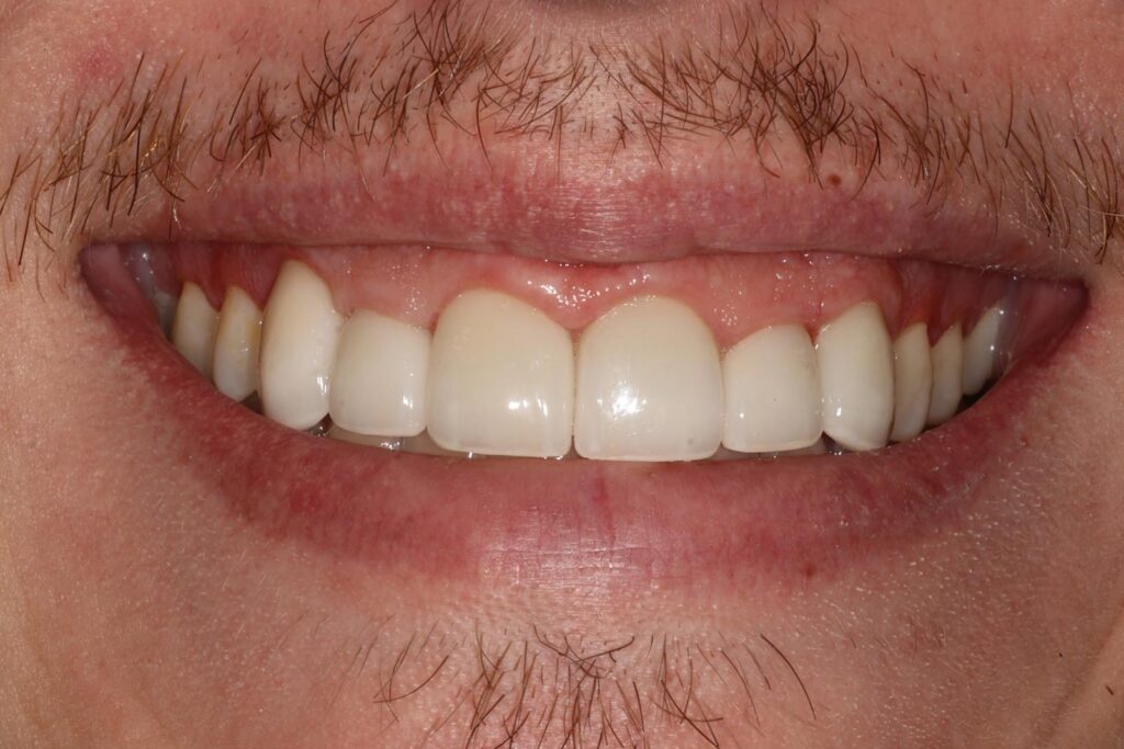 Close-up of a mouth with upper teeth featuring smooth, uniform crowns or veneers and visible gums. The lips are slightly raised, highlighting the contrast between restored teeth and natural oral features.