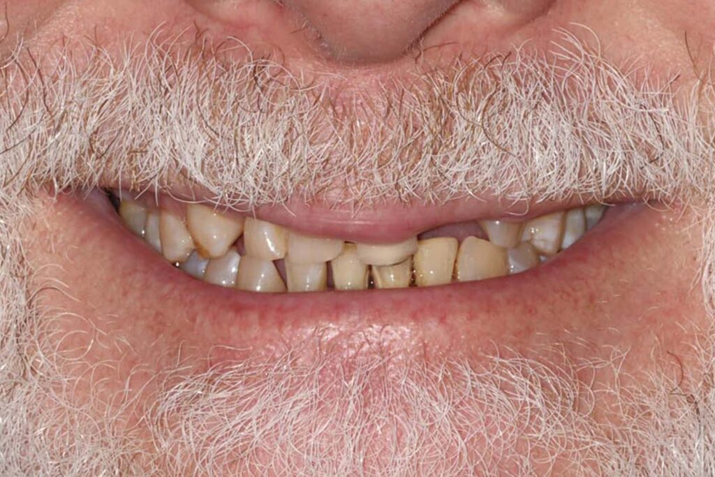 Close-up of a mouth with visible facial hair showing discolored, stained, and misaligned teeth. The mustache and beard contain white and gray strands, emphasizing age-related dental changes.