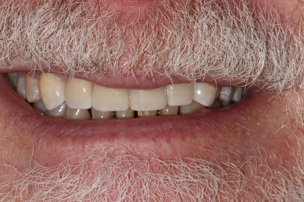 Close-up of a mouth with visible facial hair showing teeth with mixed dental restorations, discoloration, and wear. The image highlights variation in crown shades and gum visibility, useful for cosmetic or clinical evaluation.