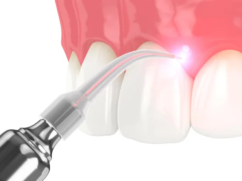 Soft-Tissue Dental Laser in Eugene & Florence, OR at Distinctive Dentistry